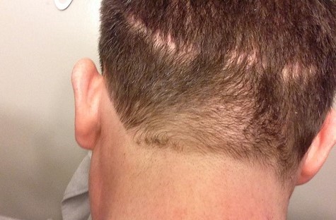 FUT Strip Scar.jpg