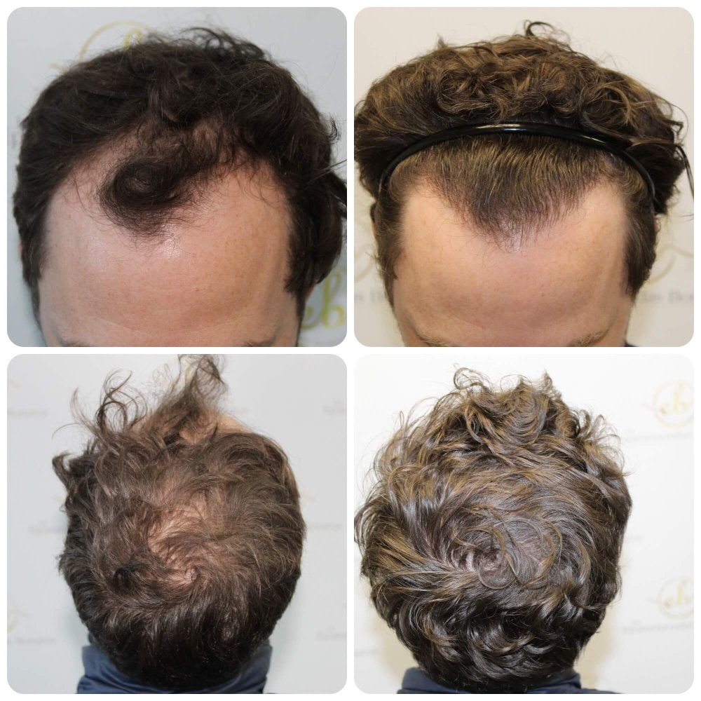 Dr Bonaros, Glasgow, UK / 2003 FUE grafts / 012 Months Hair loss