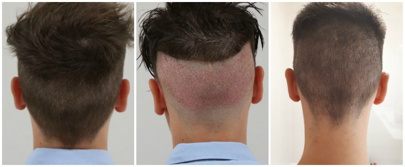 Glenn voor en na 2000 graft full partial shaven.jpg