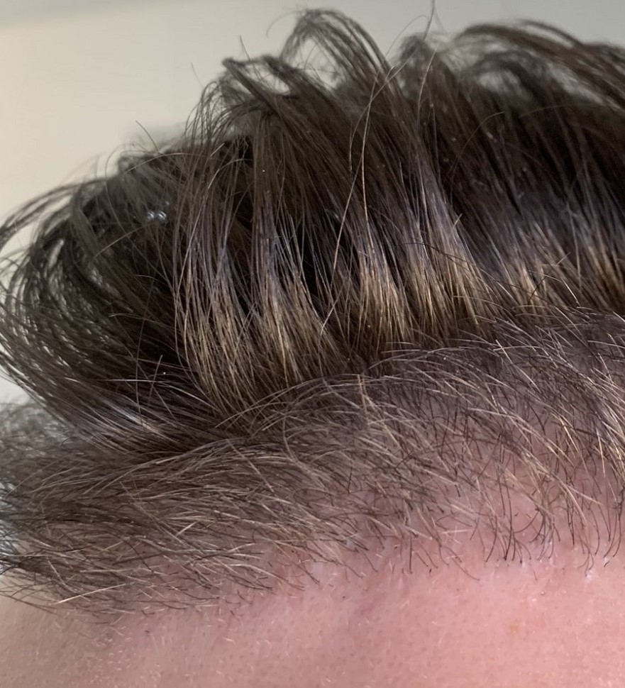 Hair Dr Leeds hair transplant repair.jpeg