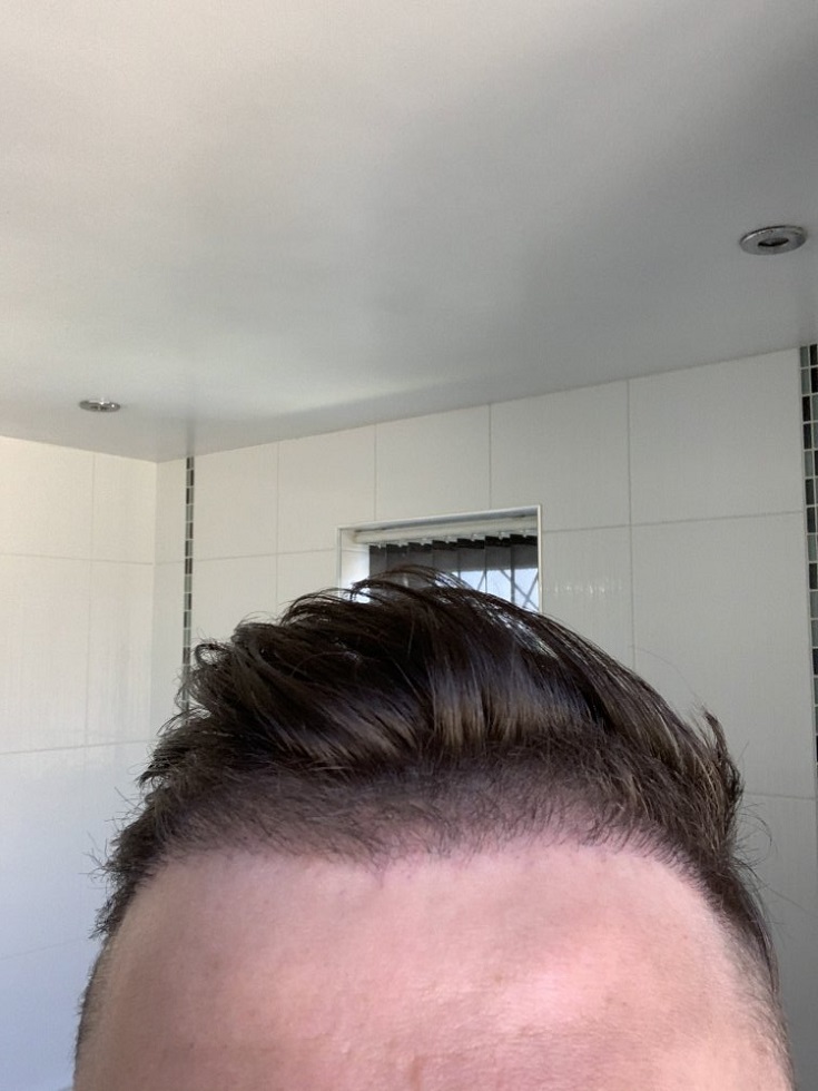 Hair Dr Leeds hair transplant repair..jpeg