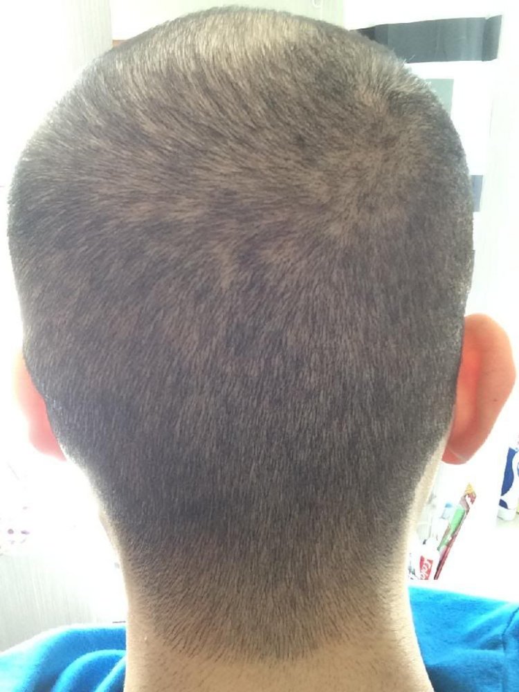 Hair loss in my twenties11.jpg