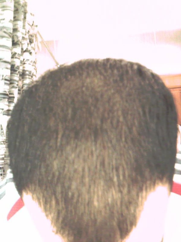 Hair loss in my twenties2.jpg