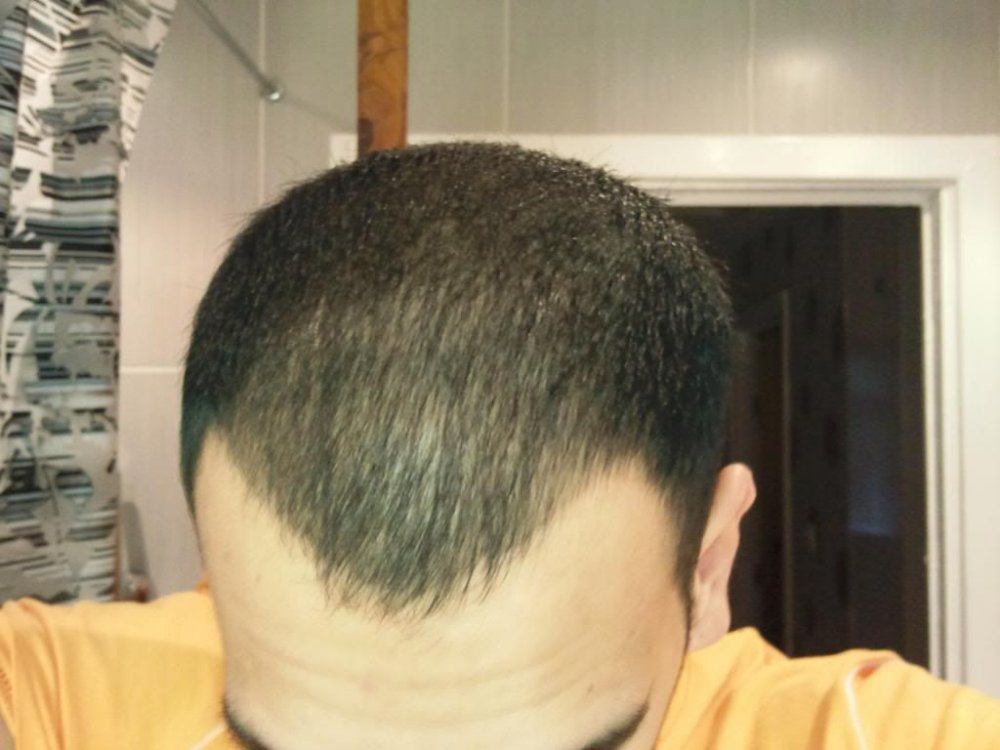 Hair loss in my twenties5.jpg