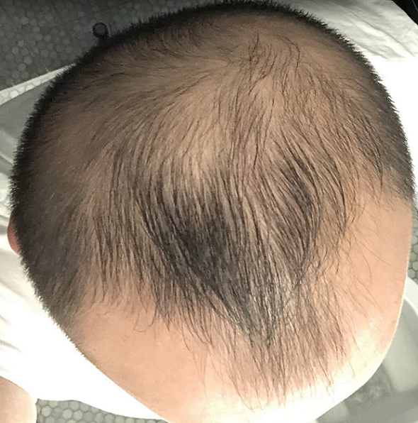 Hair loss.png