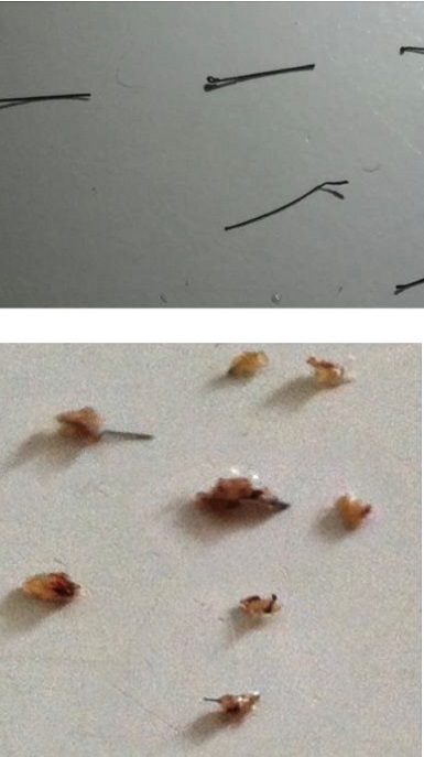 Hair shedding scabs and grafts..jpg