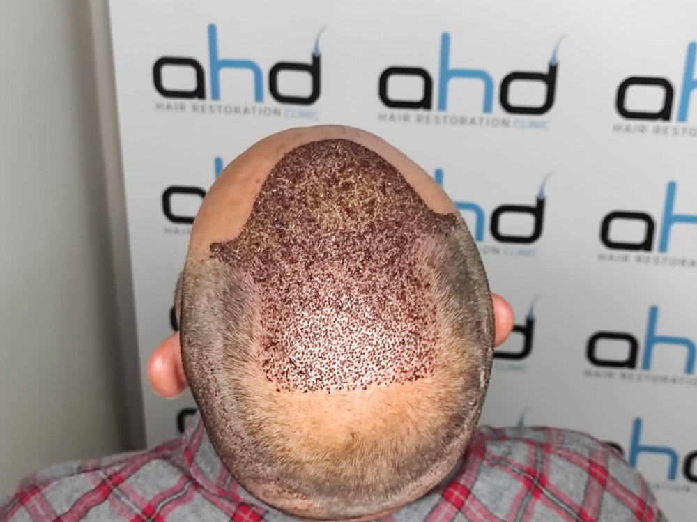 hair transplant 3.jpeg