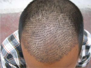 hair-transplant-300x224.jpg