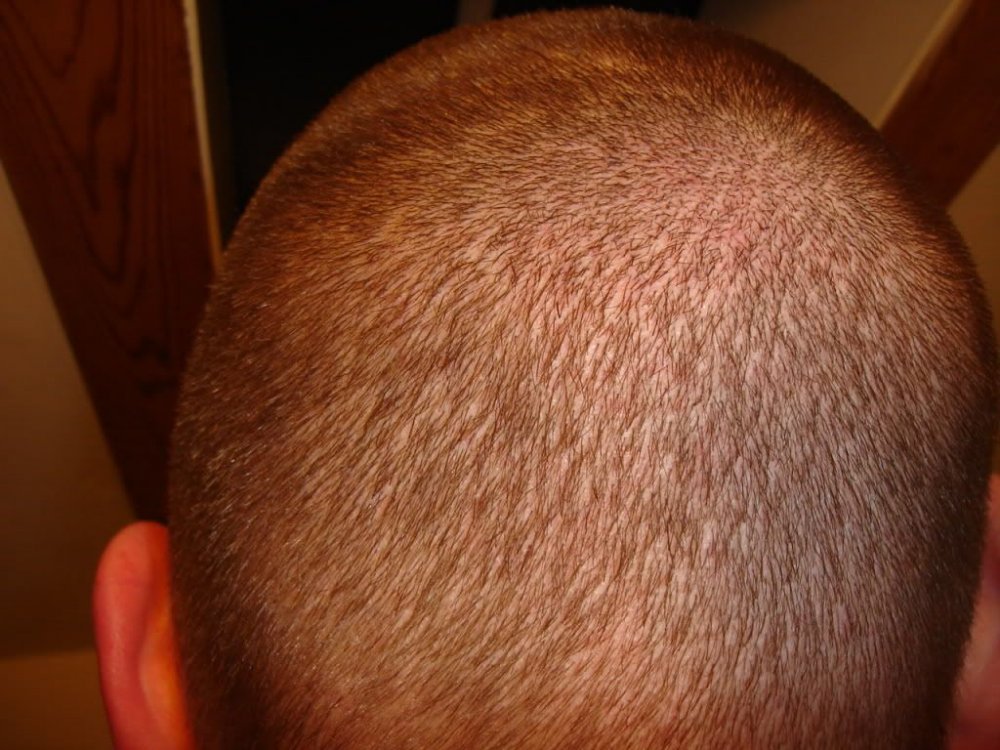 Hair Transplant at BHR Clinic 1.jpg