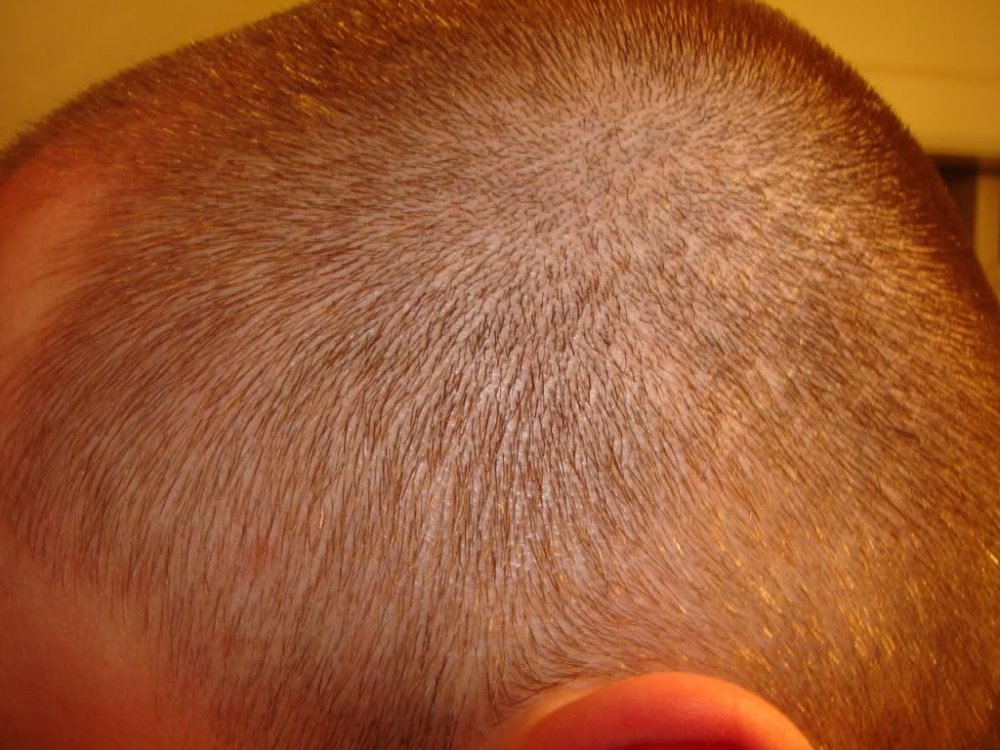 Hair Transplant at BHR Clinic 2.jpg