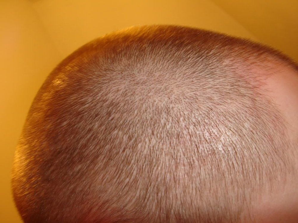 Hair Transplant at BHR Clinic 3.jpg