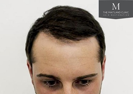 Hair transplant at The Maitland Clinic 1.jpg