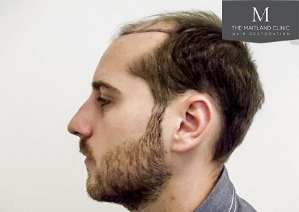 Hair transplant at The Maitland Clinic 2.jpg