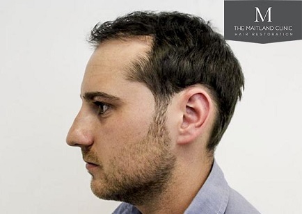 Hair transplant at The Maitland Clinic 3.jpg