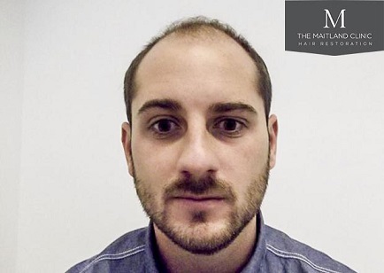 Hair transplant at The Maitland Clinic 5.jpg