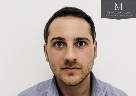 Hair transplant at The Maitland Clinic 6.jpg