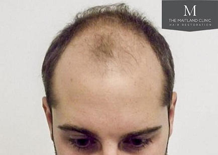 Hair transplant at The Maitland Clinic.jpg