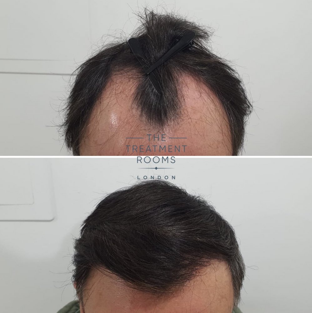 Hair transplant before and after 1800 grafts.jpg