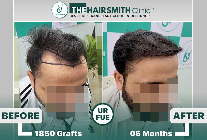 hair transplant before and after result.jpg