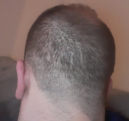 Hair Transplant donor area.jpg