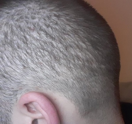Hair Transplant donor zone..jpg