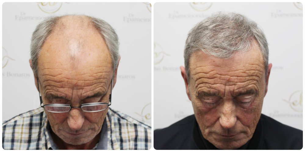 hair-transplant-dr-bonaros-scotland (1).jpg