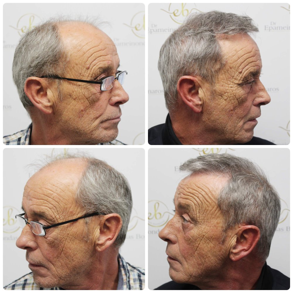 hair-transplant-dr-bonaros-scotland (2).jpg