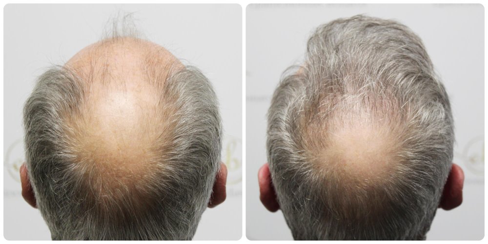 hair-transplant-dr-bonaros-scotland (3).jpg