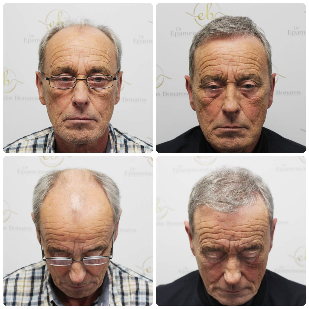 hair-transplant-dr-bonaros-scotland (4).jpg