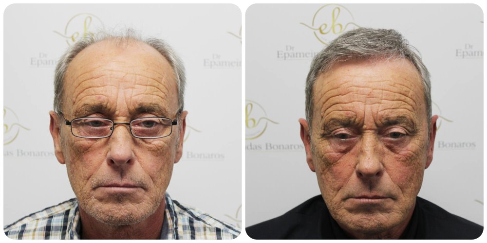 hair-transplant-dr-bonaros-scotland.jpg