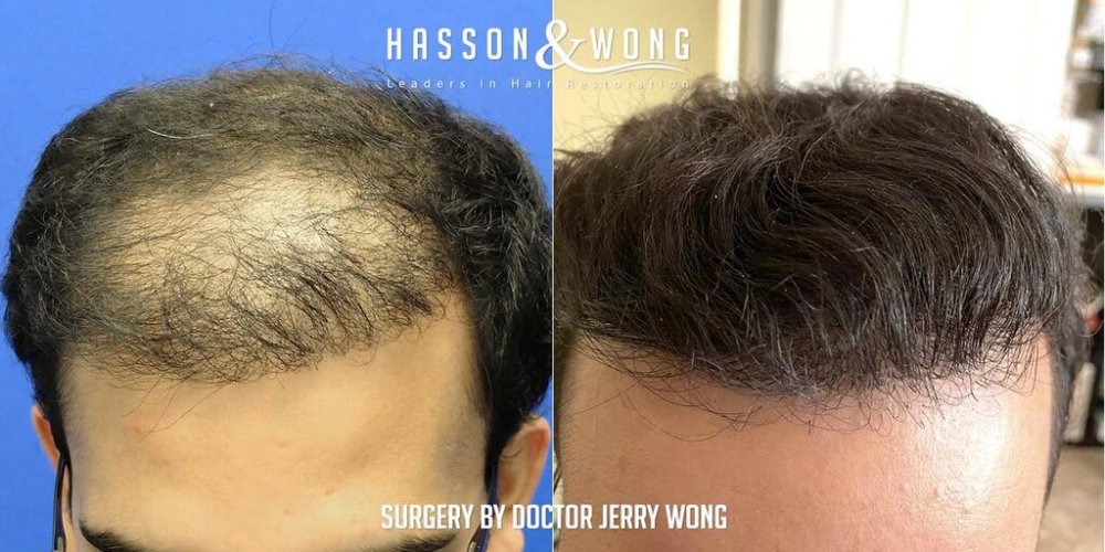 Hair transplant Dr. Wong 1.jpg