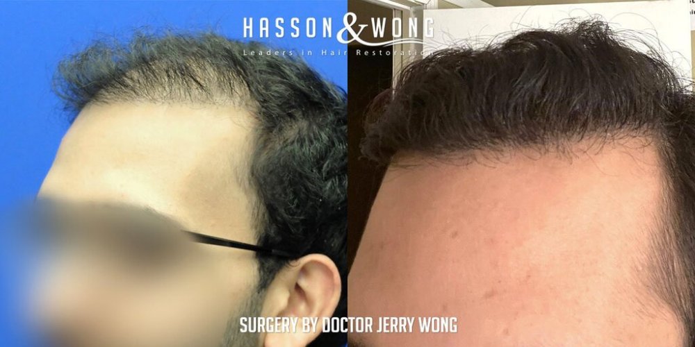 Hair transplant Dr. Wong 2.jpg