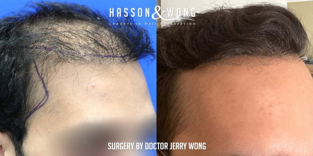 Hair transplant Dr. Wong 3.jpg