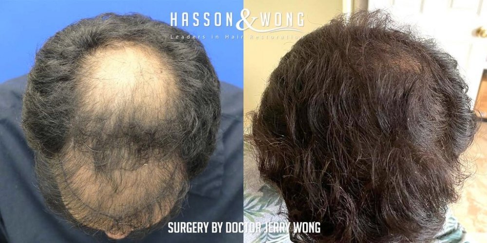 Hair transplant Dr. Wong 4.jpg