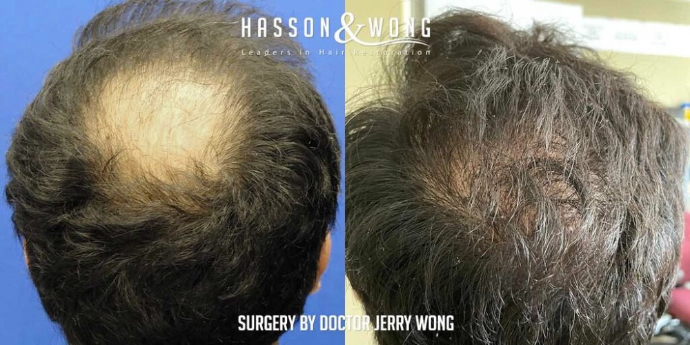 Hair transplant Dr. Wong 5.jpg
