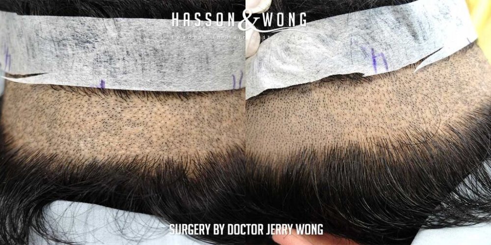 Hair transplant Dr. Wong 6.jpg
