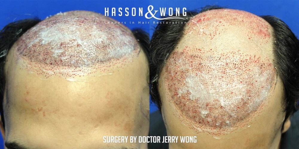 Hair transplant Dr. Wong 7.jpg