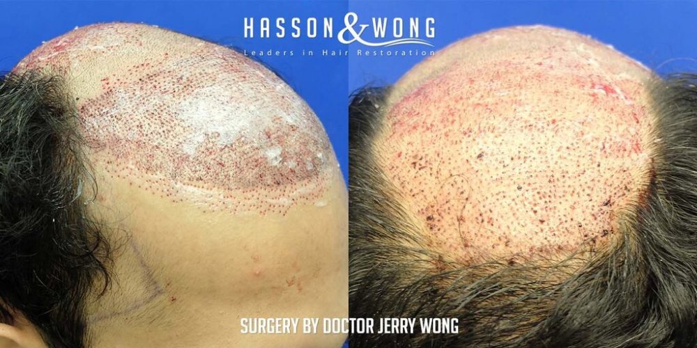 Hair transplant Dr. Wong 8.jpg