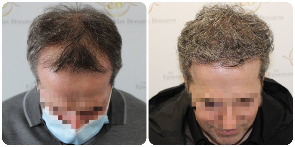Dr Bonaros, Glasgow, UK / 3595 FUE grafts / 012 Months Hair loss