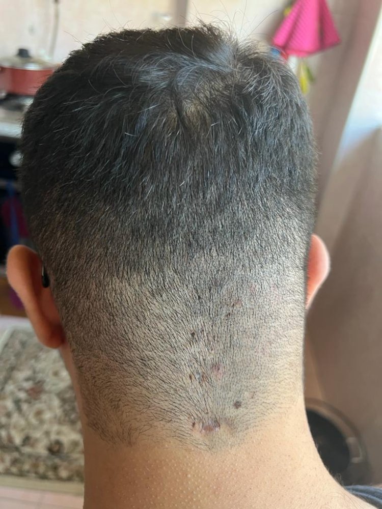 Hair transplant graft estimate1.jpg