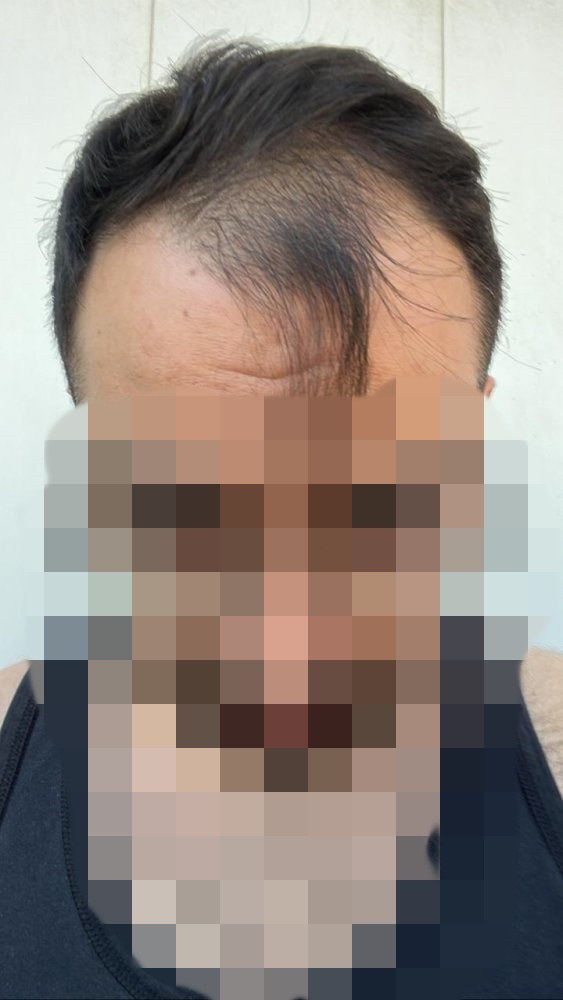 Hair transplant graft estimate10.jpg