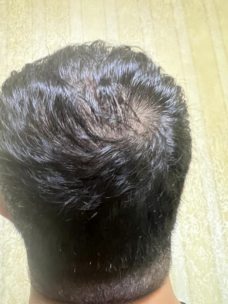 Hair transplant graft estimate2.jpg