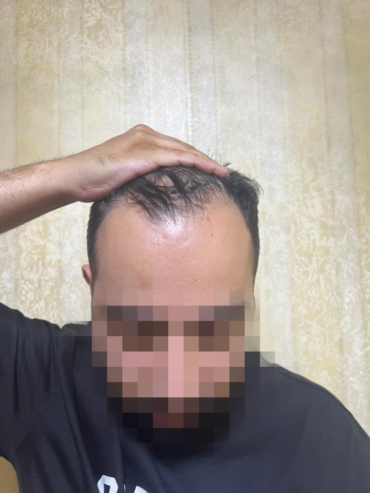 Hair transplant graft estimate3.jpg