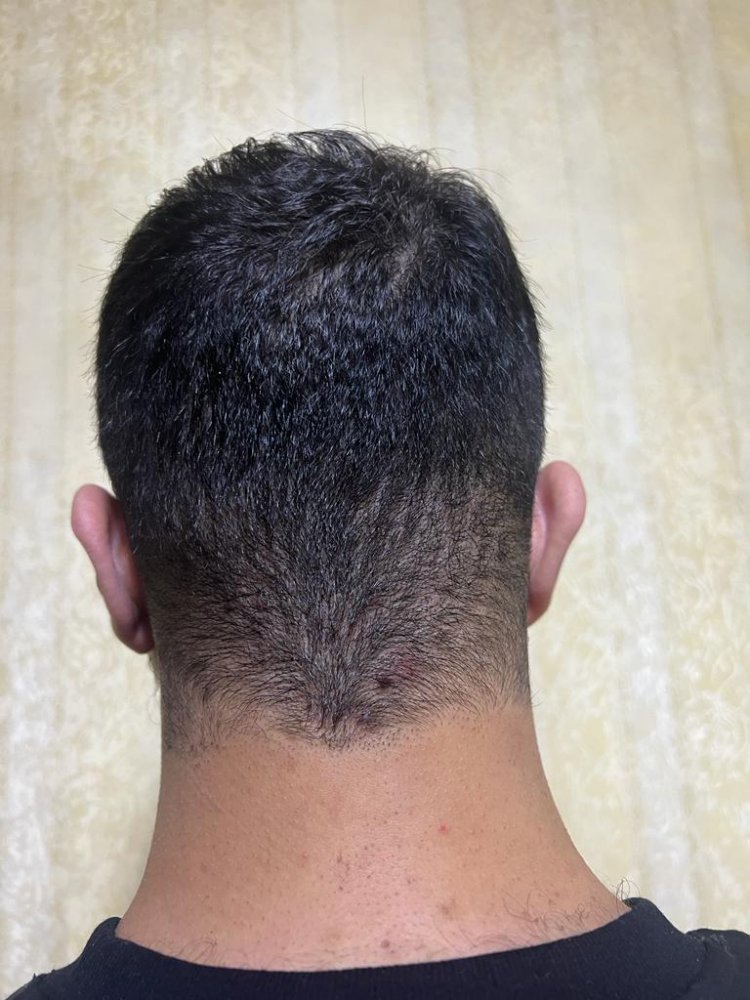 Hair transplant graft estimate4.jpg