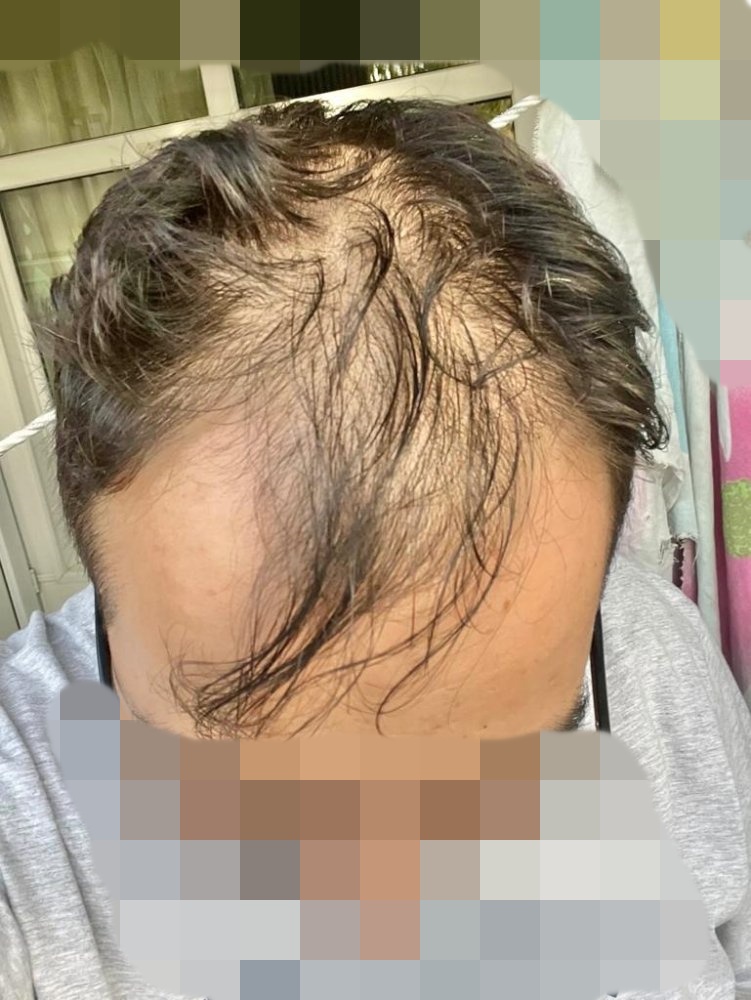 Hair transplant graft estimate5.jpg