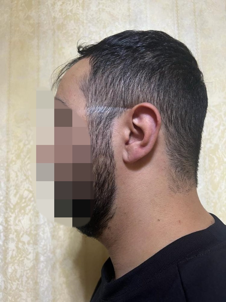 Hair transplant graft estimate6.jpg