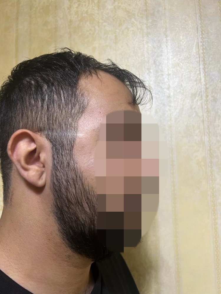 Hair transplant graft estimate7.jpg