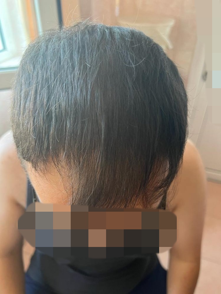 Hair transplant graft estimate8.jpg