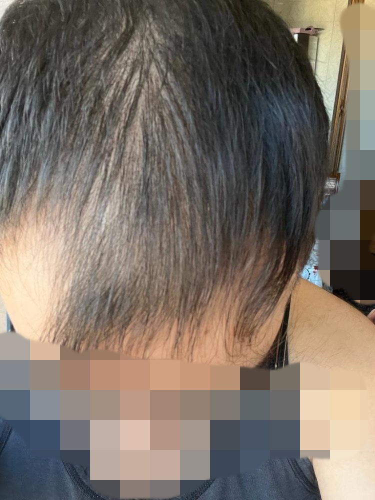 Hair transplant graft estimate9.jpg