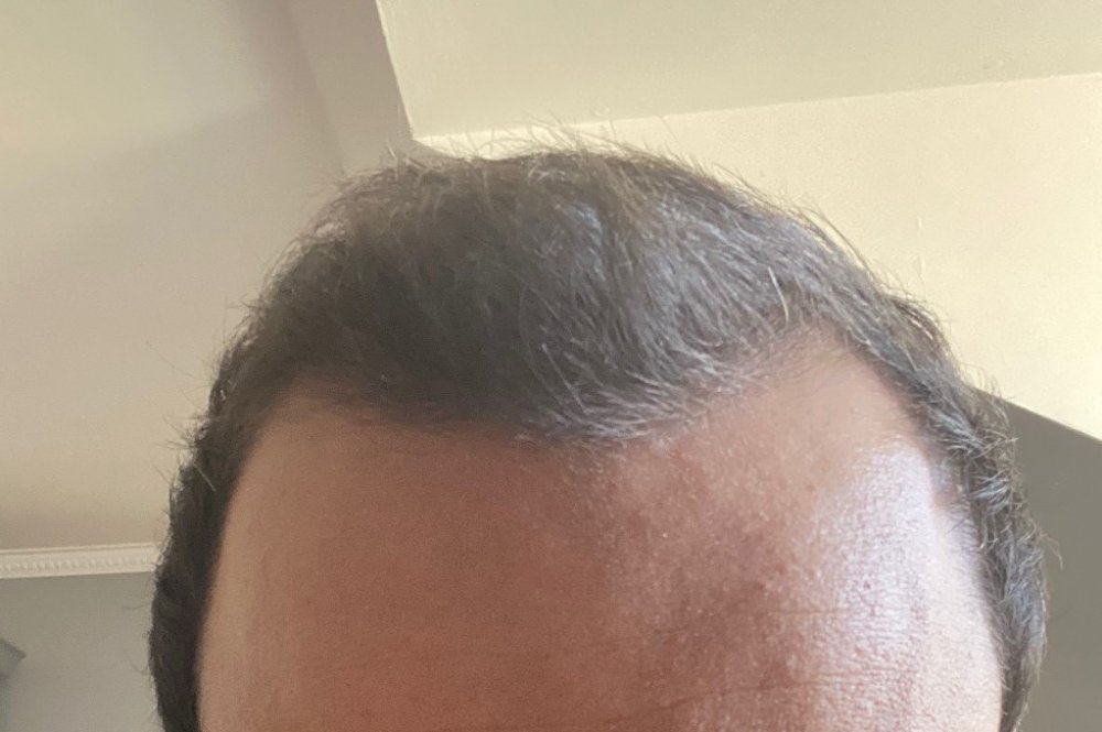 hair transplant growth.jpeg